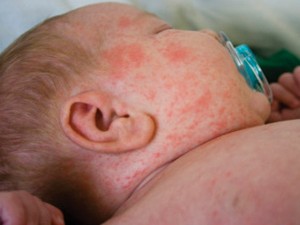 measles1