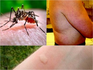 Mosquito Bite Appearances